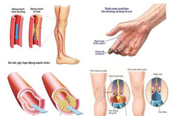 Bệnh lý mạch máu ngày càng trẻ hóa