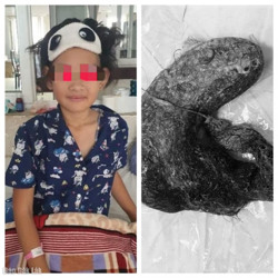 Phẫu thuật thành công cho bệnh nhi mắc hội chứng Rapunzel (rối loạn ăn tóc)