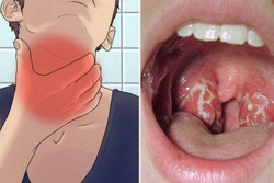 Dấu hiệu cảnh báo lây nhiễm vi khuẩn bạch hầu