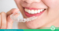 Niềng răng hiệu quả: Tất tần tật những điều bạn cần biết