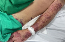 Chế biến thủ lợn đãi bạn bè, người đàn ông nguy kịch