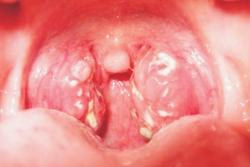 Tăng cường công tác phòng chống dịch bệnh bạch hầu