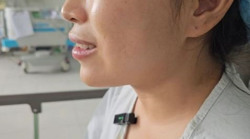 Người phụ nữ gặp nạn sau 5 năm phẫu thuật tạo má lúm đồng tiền