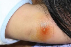 Nặn mụn có thể dẫn tới nhiễm khuẩn huyết