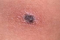 Không chủ quan với sốt mò