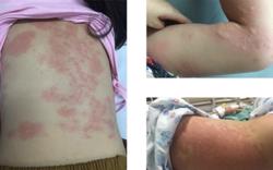Cảnh giác triệu chứng nổi mề đay cấp ở trẻ