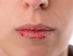 Mách bạn cách trị môi khô bong tróc hiệu quả ngay tại nhà