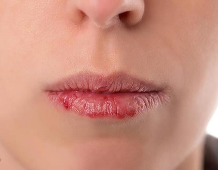 Mách bạn cách trị môi khô bong tróc hiệu quả ngay tại nhà