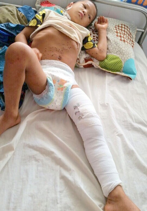 Bé Nhảy đang được điều trị tại Bệnh viện Đa khoa huyện Đắk Mil